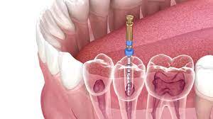 A close-up of a tooth which is equiped by the equipment.